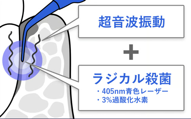 Blue Radical（ブルーラジカル）の超音波振動とラジカル殺菌の説明図