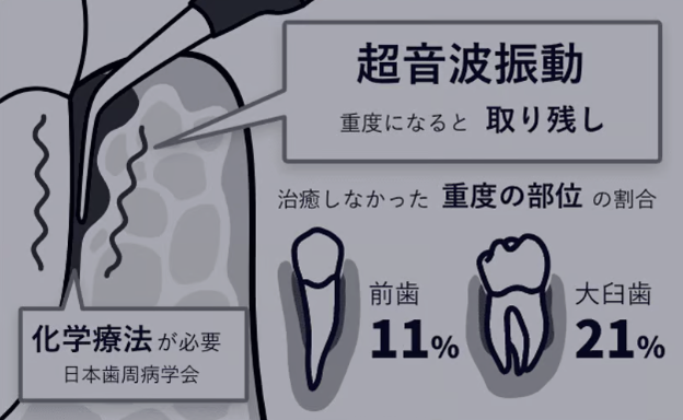 従来の治療法で超音波振動のみを用いる場合の説明図