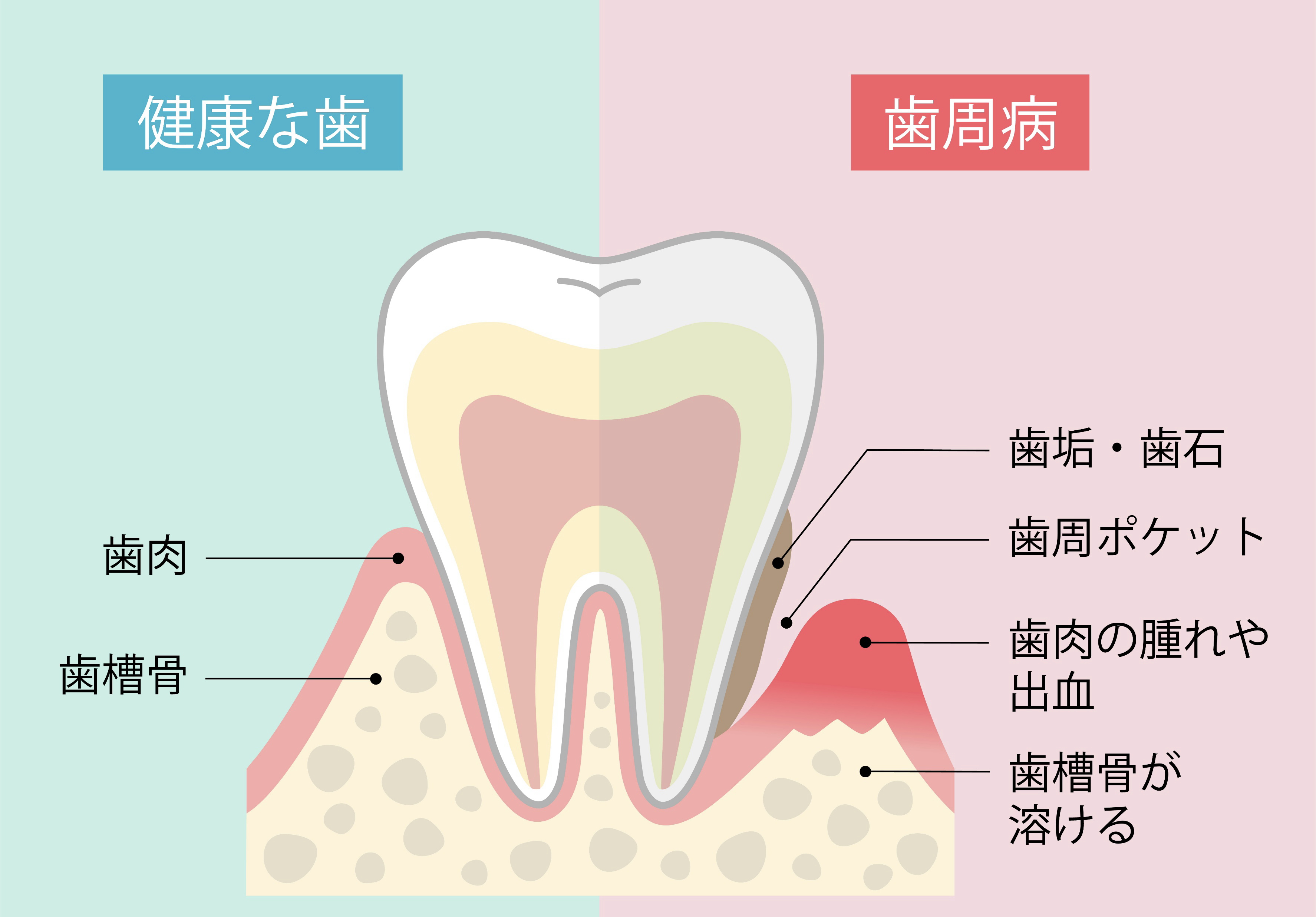 健康な歯と歯周病の違い、歯肉、歯槽骨、歯周ポケットを示した図