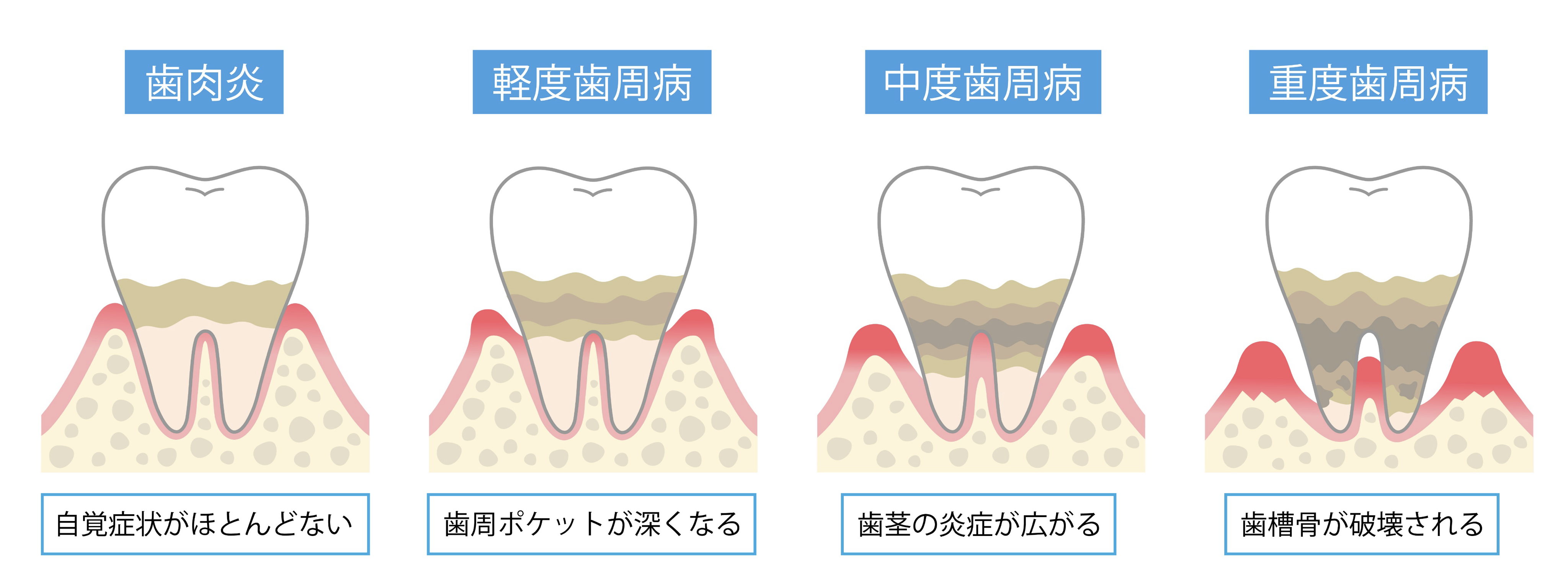 歯肉炎から重度歯周病までの進行段階を示した図