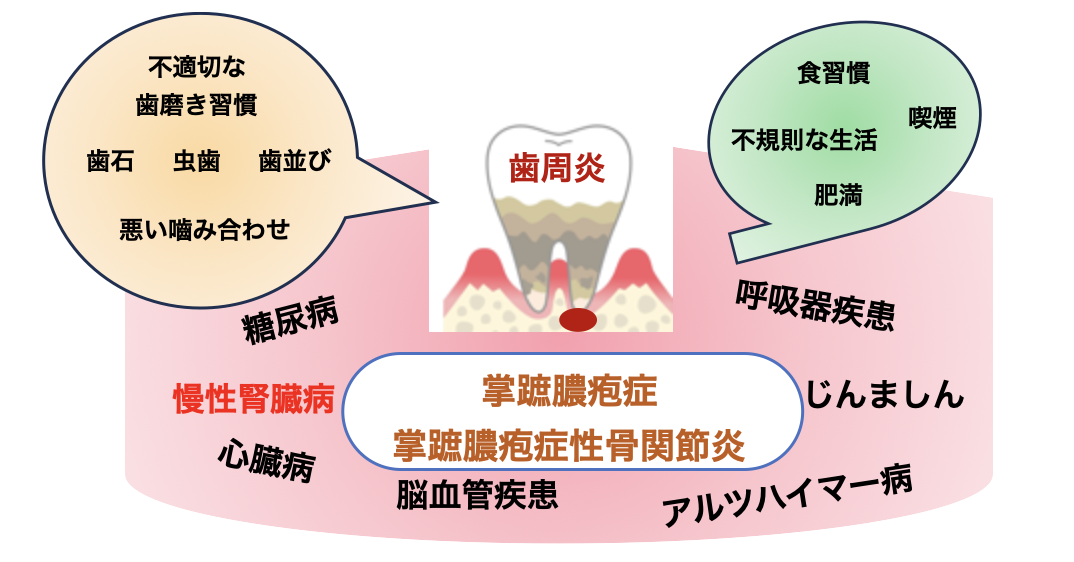 歯周炎と全身の健康との関連を示した図
